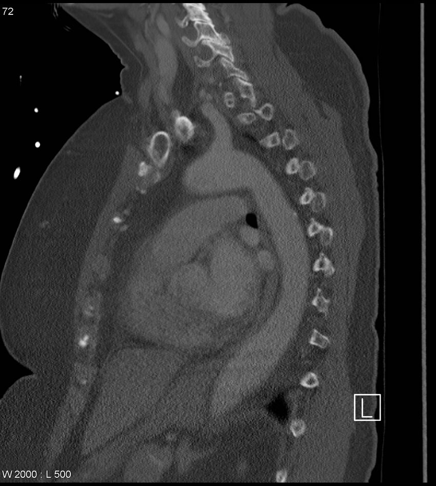 Anterior shoulder dislocation (CT) (Radiopaedia 59032-66309 Sagittal bone window 36).jpg