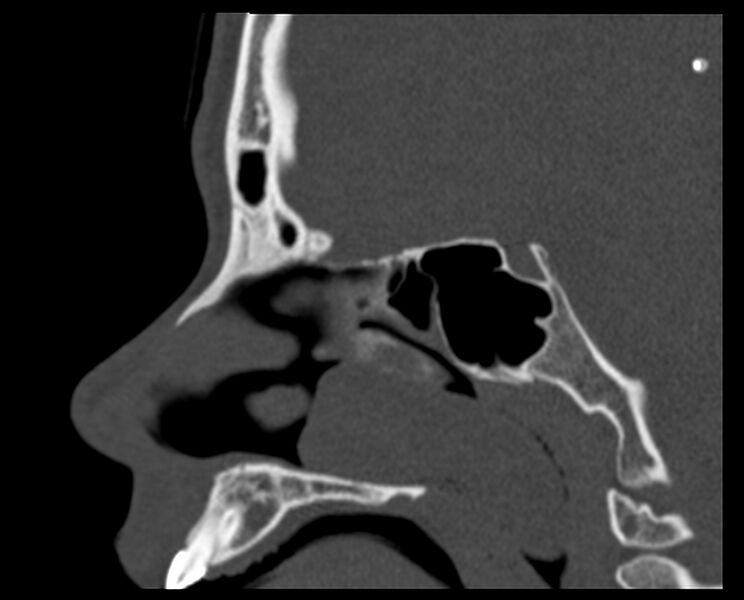 File:Antrochoanal polyp (Radiopaedia 21894-21868 Sagittal bone window 18).jpg