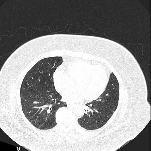 File:Aortic arch false aneurysm (Radiopaedia 14667-14587 Axial lung window 15).jpg
