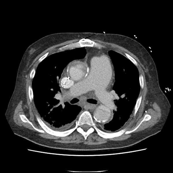 File:Aortic arch graft infection (FDG PET-CT) (Radiopaedia 71975-82437 A 24).jpg