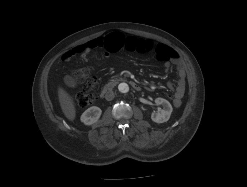 File:Aortic dissection (Radiopaedia 28802-29105 A 60).jpg