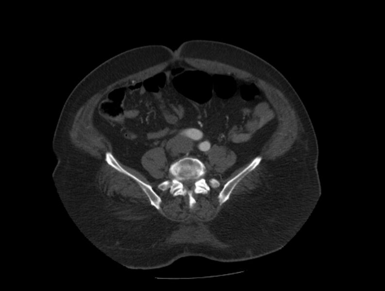 File:Aortic dissection (Radiopaedia 28802-29105 A 79).jpg