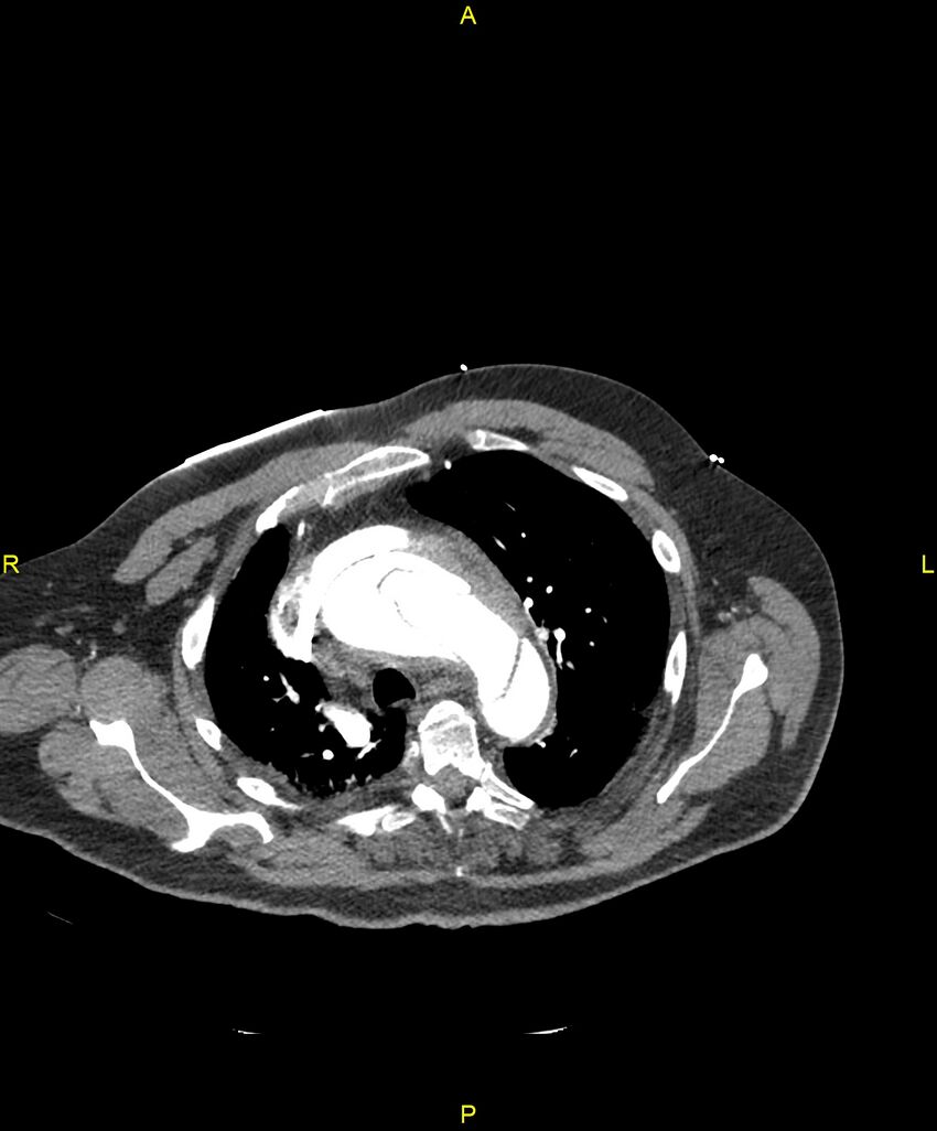 Aortic rupture (Radiopaedia 88822-105594 B 69).jpg