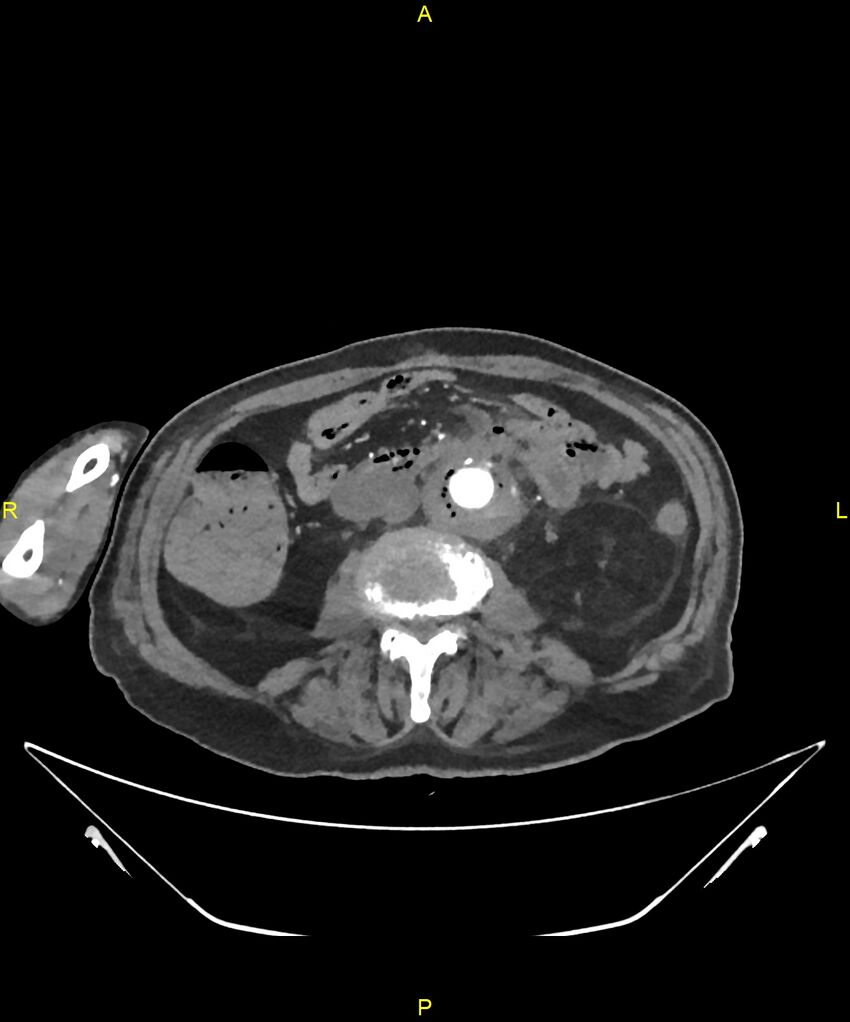 Aortoenteric fistula (Radiopaedia 84308-99603 B 195).jpg