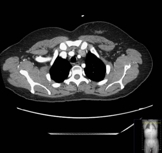 File:Appendicitis (CT angiogram) (Radiopaedia 154713-127660 Axial 229).jpg