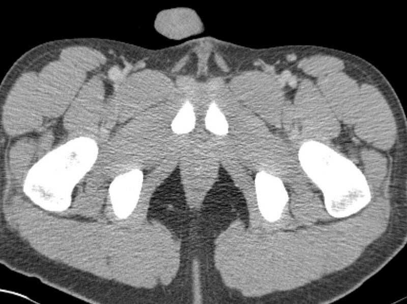 File:Appendicitis and incidental foregut duplication cyst (Radiopaedia 52962-58916 A 111).jpg
