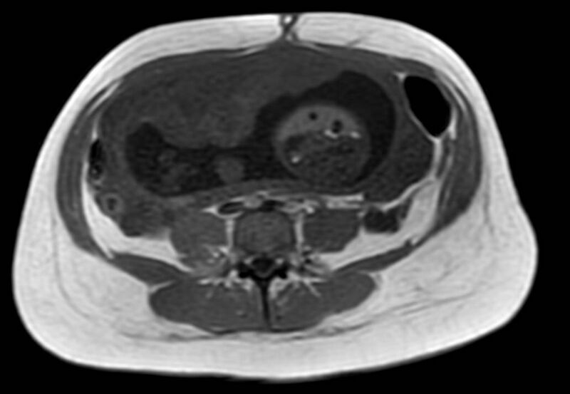 File:Appendicitis in gravida (MRI) (Radiopaedia 89433-106395 Axial T1 in-phase 41).jpg