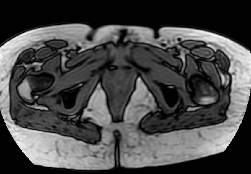 Appendicitis in gravida (MRI) (Radiopaedia 89433-106395 D 72).jpg