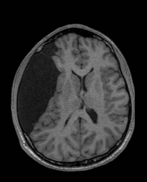 File:Arachnoid cyst- extremely large (Radiopaedia 68741-78451 Axial T1 45).jpg