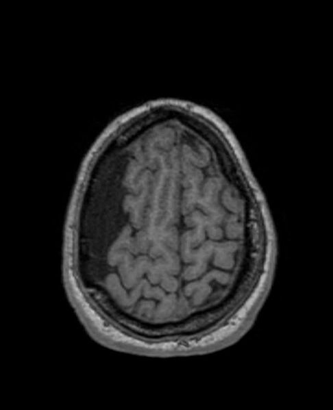 File:Arachnoid cyst- extremely large (Radiopaedia 68741-78451 Axial T1 68).jpg