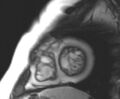 Arrhythmogenic right ventricular cardiomyopathy (Radiopaedia 69431-79307 Short axis cine 38).jpg