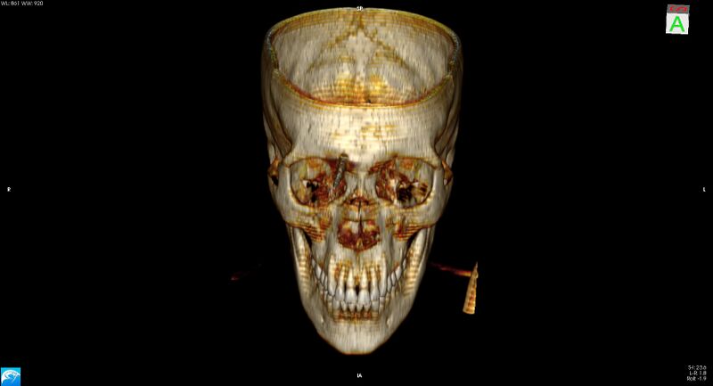 File:Arrow injury to the brain (Radiopaedia 72101-82607 3D bone 7).jpg