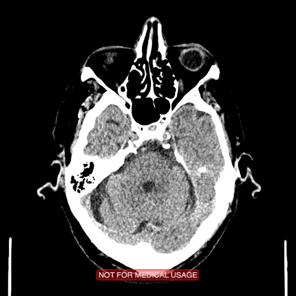 File:Artery of Percheron infarction (Radiopaedia 28679-28967 Axial non-contrast 34).jpg