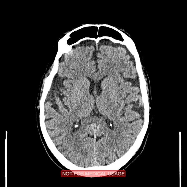 File:Artery of Percheron infarction (Radiopaedia 28679-28967 Axial non-contrast 64).jpg