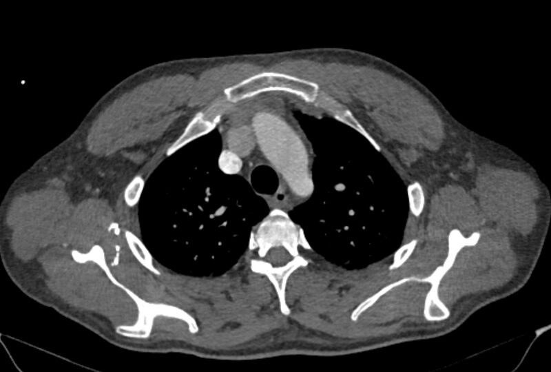 File:Ascending aortic aneurysm (Radiopaedia 86279-102297 C 11).jpg
