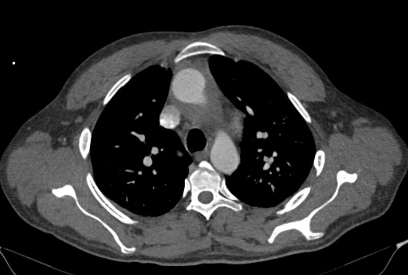 File:Ascending aortic aneurysm (Radiopaedia 86279-102297 C 16).jpg