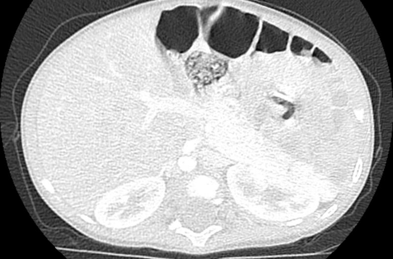File:Asplenia syndrome (Radiopaedia 73083-83792 Axial lung window 82).jpg