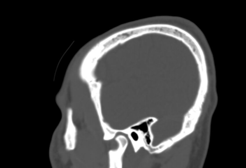 Asymptomatic occipital spur (Radiopaedia 87753-104201 Sagittal bone window 270).jpg