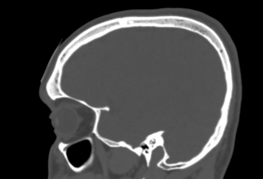 Asymptomatic occipital spur (Radiopaedia 87753-104201 Sagittal bone window 77).jpg