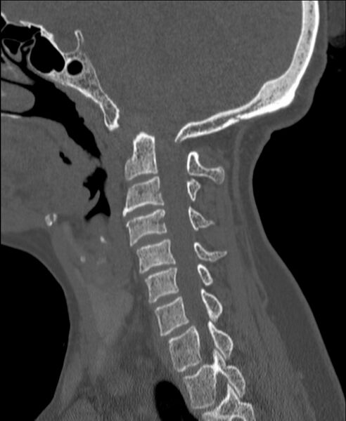 File:Atlanto-occipital assimilation with basilar invagination (Radiopaedia 70122-80188 Sagittal bone window 44).jpg