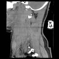 Atlanto-occipital dislocation (Radiopaedia 44648-48412 A 24).jpg