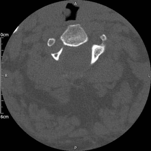 File:Atlas fracture with Currarino type A congenital defect (Radiopaedia 71747-82144 Axial bone window 60).jpg