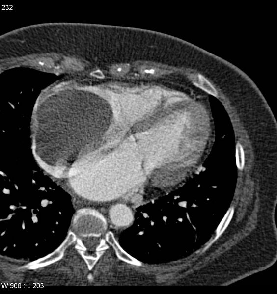 File:Atrial myxoma (Radiopaedia 8544-9382 C+ arterial phase 4).jpg