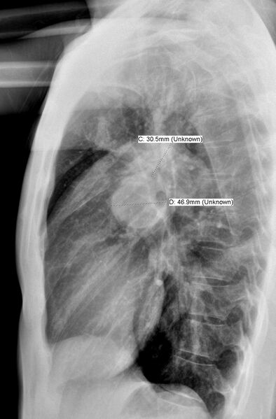 File:Atrial septal defect with pulmonary hypertension (Radiopaedia 48742-53787 Lateral 1).JPG