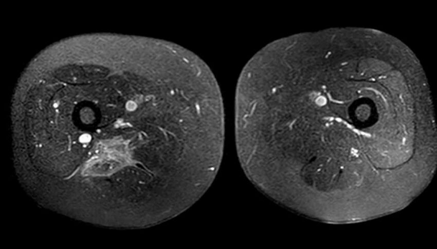 Atypical lipomatous tumor - thigh (Radiopaedia 68975-78734 Axial T1 C+ fat sat 59).jpg