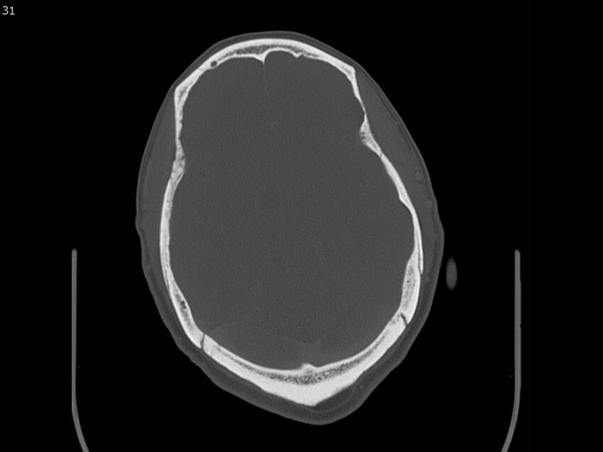 Atypical meningioma - intraosseous (Radiopaedia 64915-73867 Axial C+ bone window 31).jpg