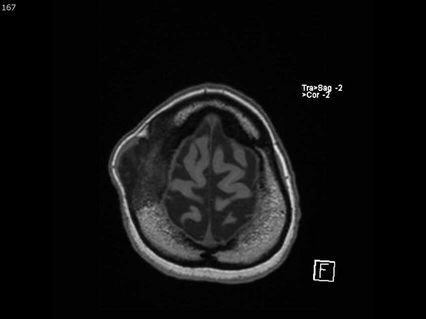 Atypical meningioma - intraosseous (Radiopaedia 64915-74572 Axial T1 167).jpg