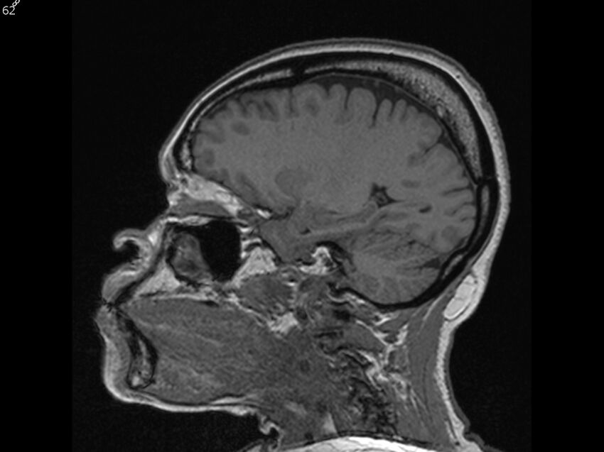 Atypical meningioma - intraosseous (Radiopaedia 64915-74572 Sagittal T1 62).jpg