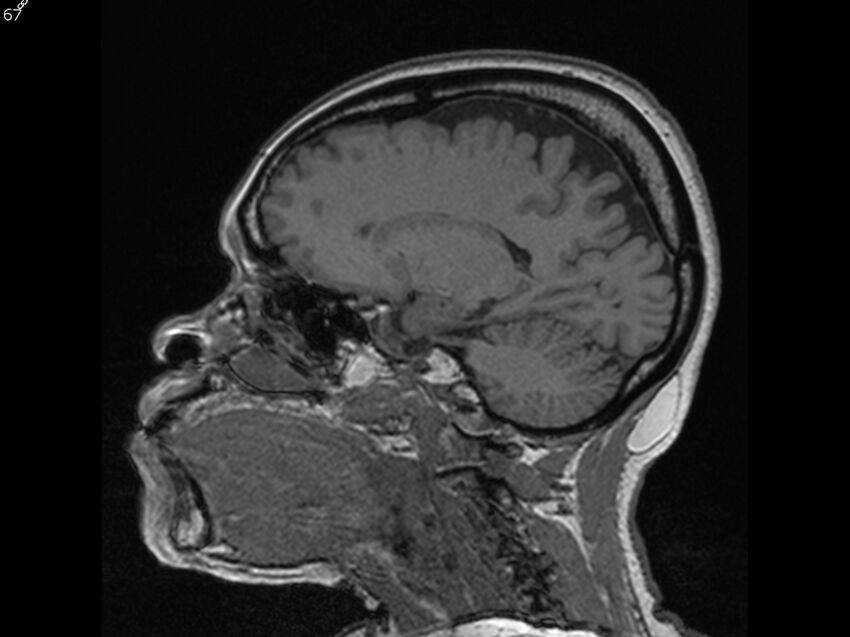 Atypical meningioma - intraosseous (Radiopaedia 64915-74572 Sagittal T1 67).jpg