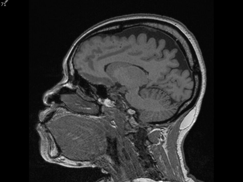 Atypical meningioma - intraosseous (Radiopaedia 64915-74572 Sagittal T1 71).jpg