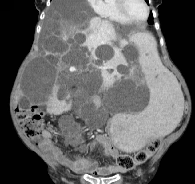 File:Autosomal dominant polycystic kidney disease (Radiopaedia 16777-16490 B 14).jpg