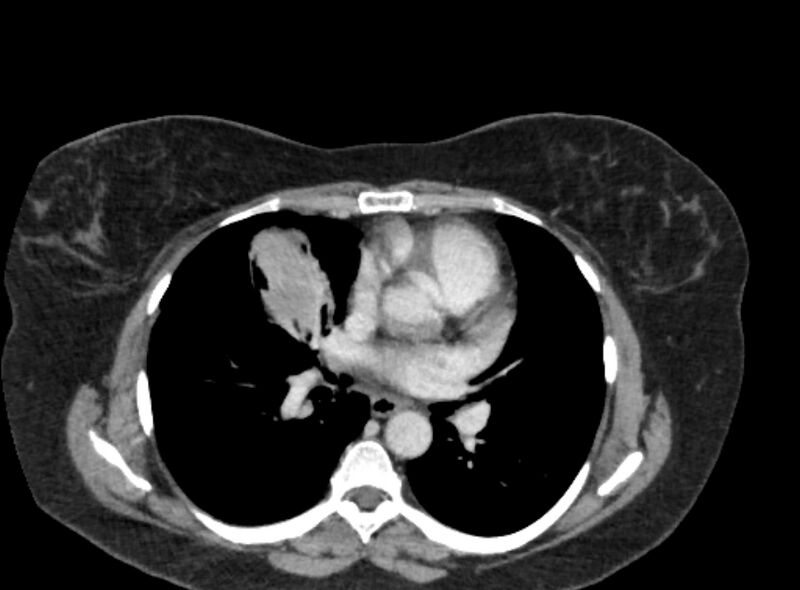 File:Autosomal dominant polycystic kidney disease (Radiopaedia 57124-64017 A 2).jpg