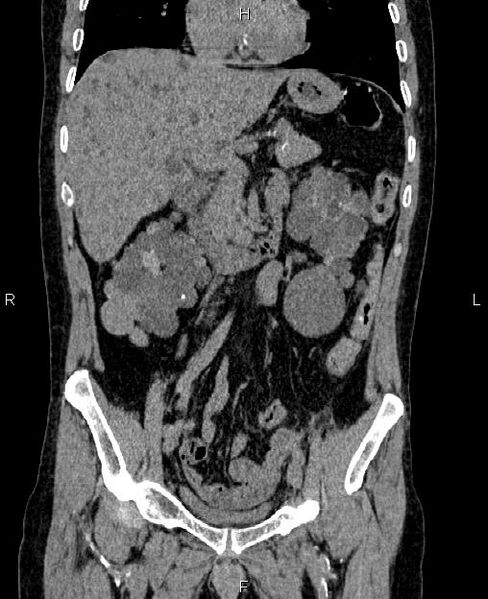 File:Autosomal dominant polycystic kidney disease (Radiopaedia 87830-104287 Coronal non-contrast 25).jpg