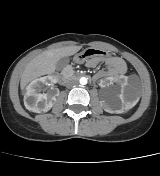 File:Autosomal dominant polycystic kidney disease - early onset (Radiopaedia 40734-43387 B 30).jpg