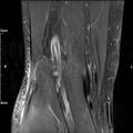 Avulsion fracture of the fibular head (Radiopaedia 74804-85808 Coronal PD fat sat 32).jpg
