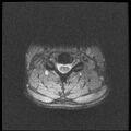 Axis fracture - MRI (Radiopaedia 71925-82375 Axial T2 fat sat 14).jpg