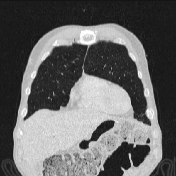 File:Azygos lobe (Radiopaedia 38259-40275 Coronal lung window 17).jpg