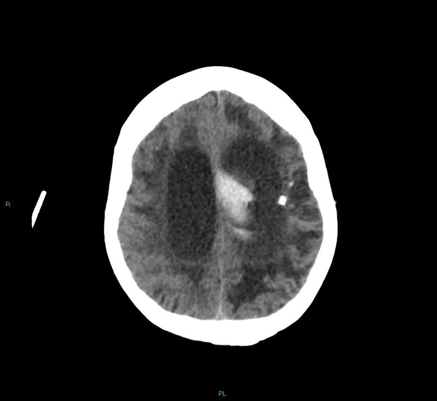 Basal ganglia hemorrhage (Radiopaedia 58766-65988 Axial non-contrast 20).jpg