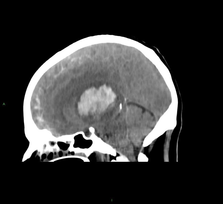 Basal ganglia hemorrhage (Radiopaedia 58775-66008 B 29).jpg