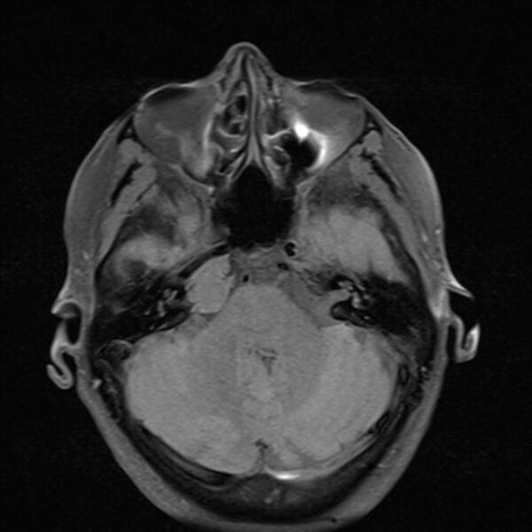 File:Base of skull chondrosarcoma (Radiopaedia 30410-31070 Axial T1 fat sat 9).jpg