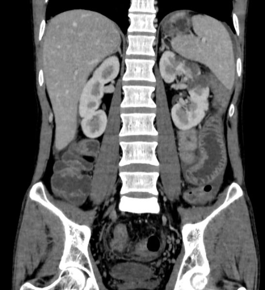 File:Behçet's disease- abdominal vasculitis (Radiopaedia 55955-62570 B 38).jpg