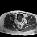 Benign seromucinous cystadenoma of the ovary (Radiopaedia 71065-81300 Axial T1 8).jpg