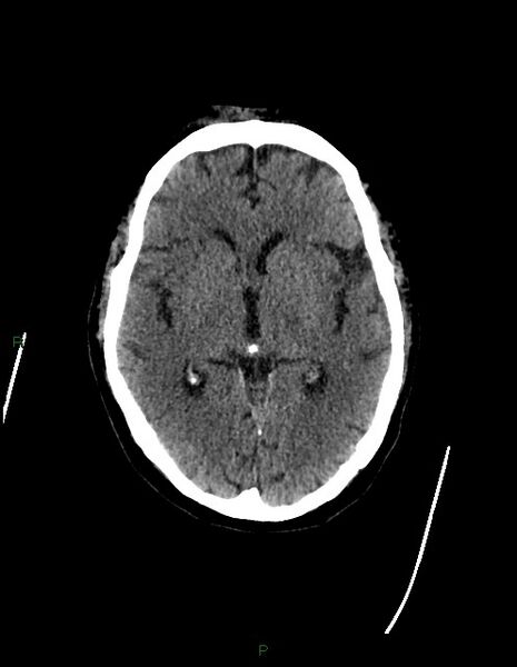 File:Bilateral acute middle cerebral artery territory infarcts (Radiopaedia 77319-89401 Axial non-contrast 41).jpg