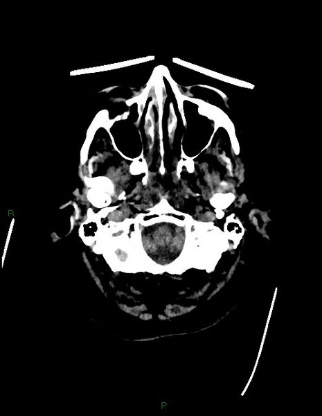 File:Bilateral acute middle cerebral artery territory infarcts (Radiopaedia 77319-89401 Axial non-contrast 7).jpg