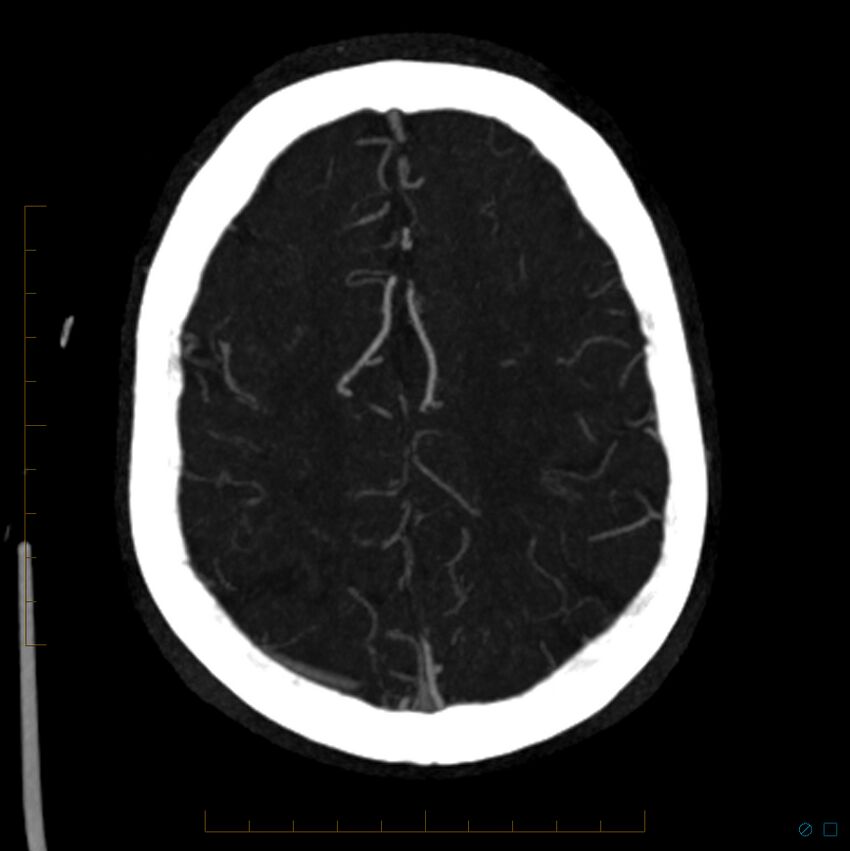 Bilateral chronic common carotid occlusion (Radiopaedia 50849-56362 D 8).jpg