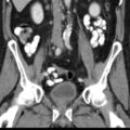 Bilateral direct inguinal herniae (Radiopaedia 17016-16719 A 20).jpg